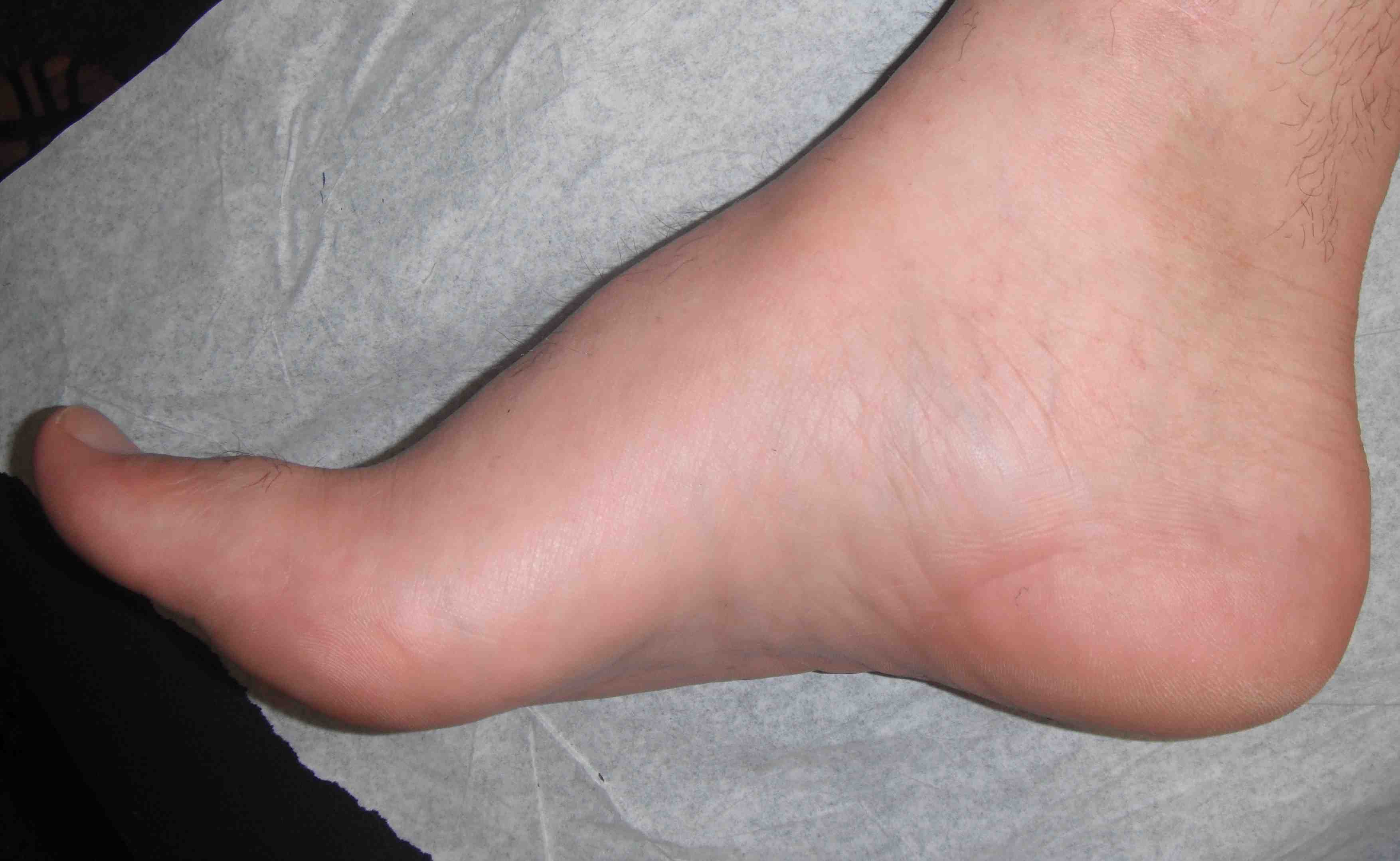 Cavus Foot
